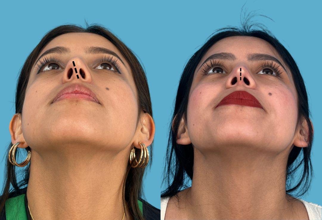 Resultado de rinoplastia, vista basal, antes y después