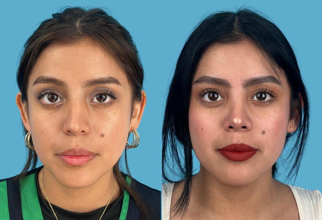 Resultado de rinoplastia, vista frontal, antes y después