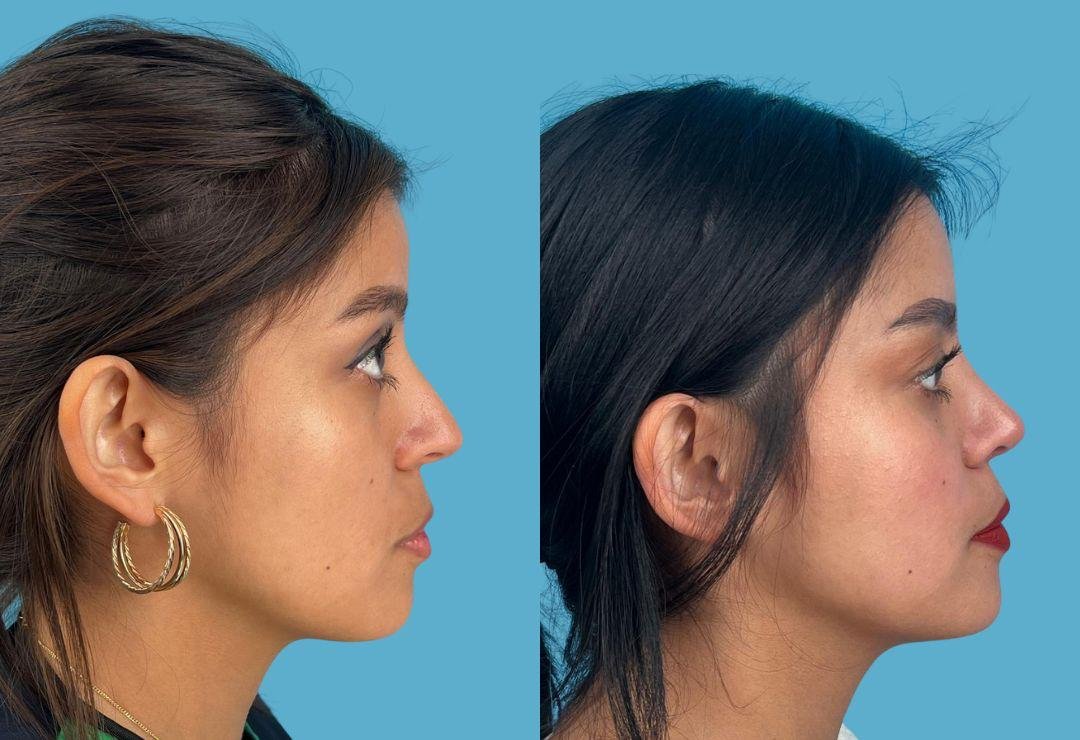 Resultado de rinoplastia, perfil derecho, antes y después