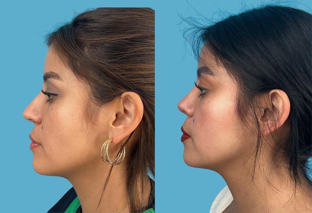 Resultado de rinoplastia, perfil izquierdo, antes y después