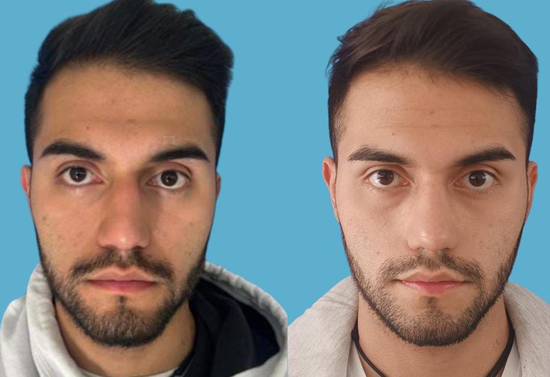 Resultado de rinoplastia, vista frontal, antes y después