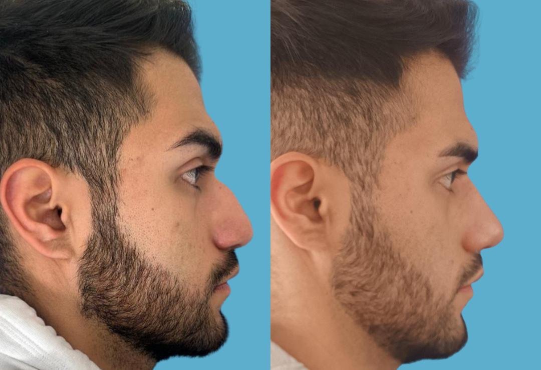 Resultado de rinoplastia, perfil derecho, antes y después
