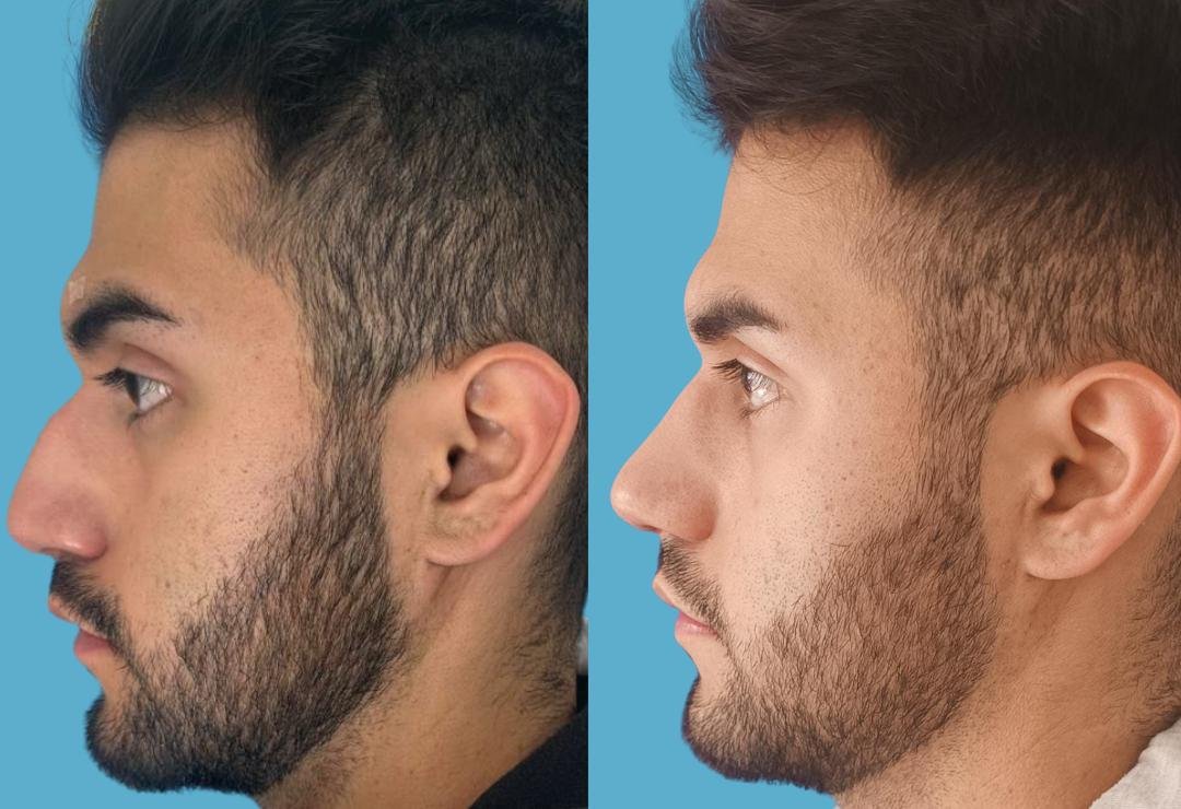 Resultado de rinoplastia, perfil izquierdo, antes y después